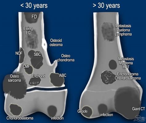 lucent bone lesions radiology assistant.